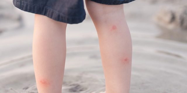 Moskitoalarm: So schützt du dein Kind vor lästigen Mückenstichen